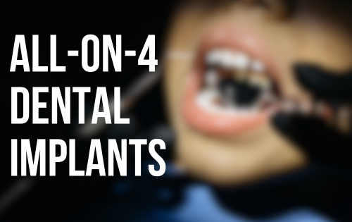 All on 4 implants