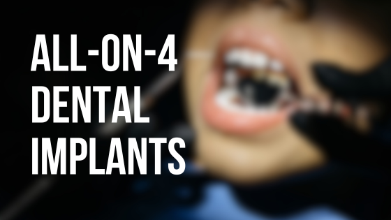 All on 4 implants